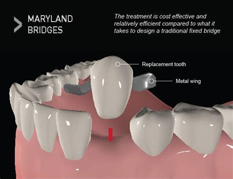 maryland bridge dental definition